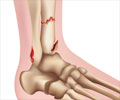 Trimalleolar Fracture - Causes, Symptoms, Diagnosis, Treatment