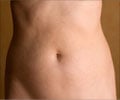 Tummy Tuck or Abdominoplasty - Indication - Procedure - Recovery - Risk - FAQs