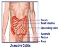 Ulcerative Colitis