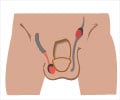 Undescended Testicles | Cryptorchidism - Causes, Complications, Diagnosis, Treatment Undescended Testicles | Cryptorchidism - Causes, Complications, Diagnosis, Treatment