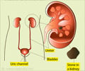 Urinary Stone Disease