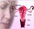 Fibroids in Uterus Fibroids in Uterus