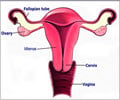 XY Females – Women or Men - Intersex -True Picture