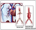 Takayasu Arteritis