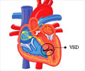 Ventricular Septal Defect (VSD)