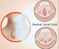 Vocal Cord Dysfunction | Vocal Cord Malfunction: Symptoms, Risk Factors, Diagnosis & Treatment
