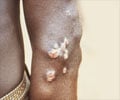 Yaws Disease - Causes, Symptoms, Diagnosis, Treatment & Prevention