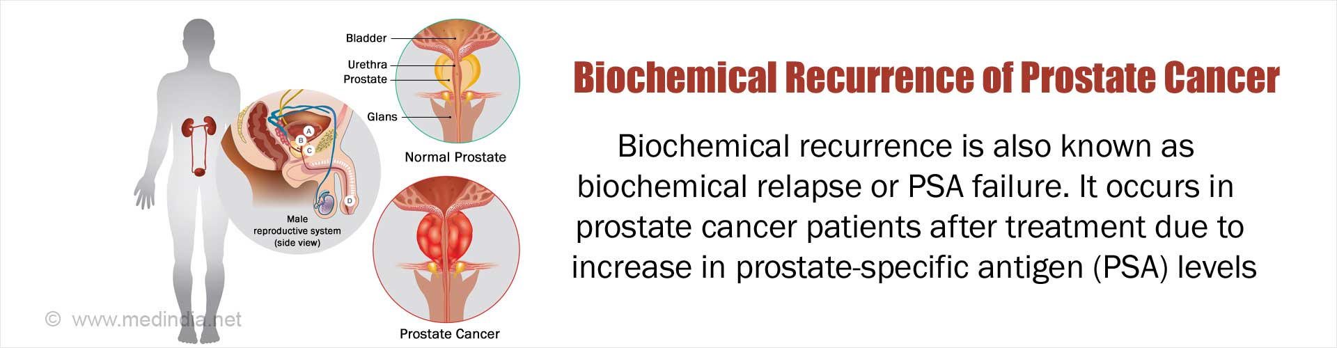 Biochemical Recurrence Of Prostate Cancer