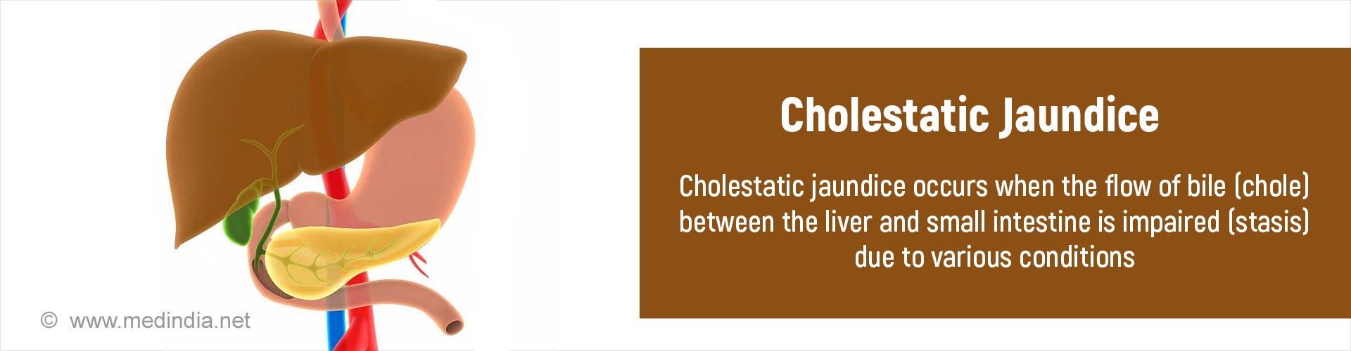 Cholestatic Jaundice Causes Symptoms Risk Factors Diagnosis Treatment And Prevention 3966