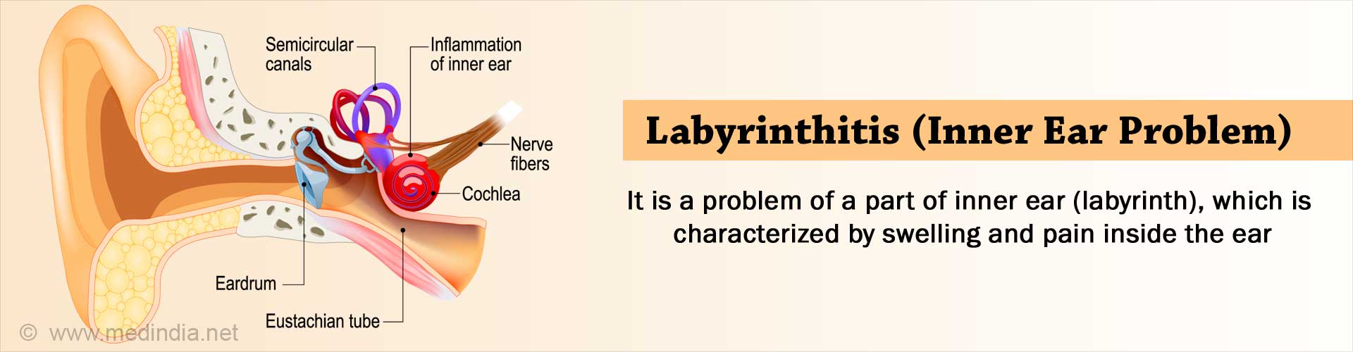 Labyrinthitis Symptoms Causes Diagnosis Treatment Prognosis