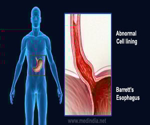 Barrett’s Esophagus - Symptoms, Diagnosis & Treatment