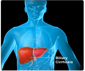 Biliary Cirrhosis - Symptoms - Diagnosis - Complications - Treatment - Video