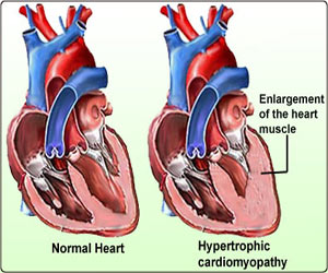 Cardiomyopathy - Dilated - Hypertrophic and Restrictive Types
