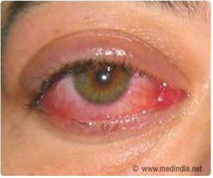Corneal Ulcer - Causes - Symptoms - Diagnosis - Treatment - FAQs