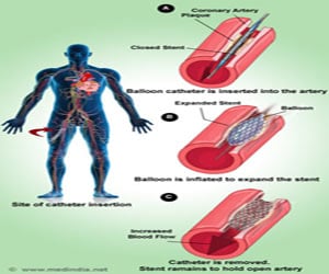 Coronary Balloon Angioplasty