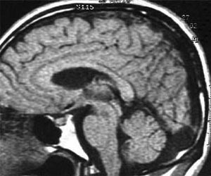 Dandy Walker Syndrome