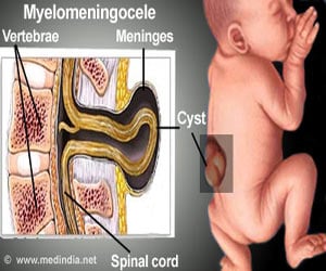 Myelomeningocele-Causes-Risk Factors-Symptoms-Treatment-Complications-Prevention