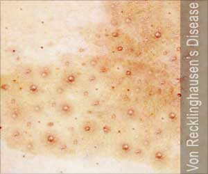 Von Recklinghausen's Disease | Neurofibromatosis Type 1