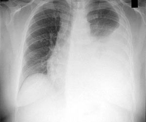 Pleural Effusion