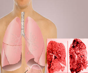 Pneumoconiosis - Definition - Symptoms - Causes - Prevention - Treatment