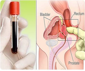 Prostate Cancer Screening