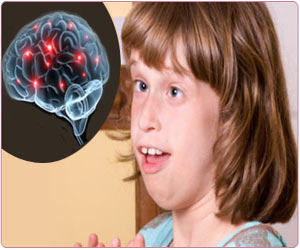 Rett Syndrome – Causes – Symptoms – Signs – Diagnosis - Treatment