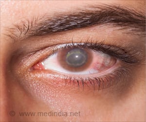 Acanthamoeba Keratitis - Symptoms, Signs, Diagnosis & Treatment