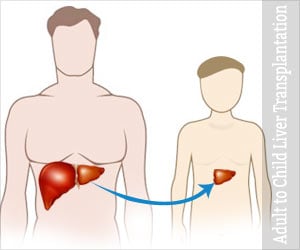 Adult to Child Living Donor Liver Transplantation