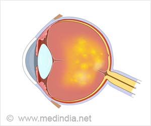 Age Related Macular Degeneration (AMD) - Causes, Symptoms, Diagnosis, Treatment & Prevention