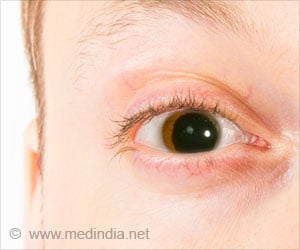 Aniridia - Causes, Symptoms, Diagnosis & Treatment