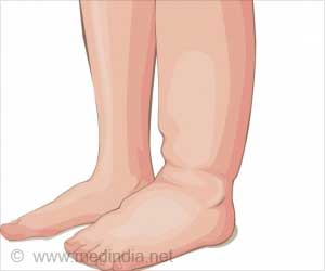 Ankle Edema / Ankle Swelling - Causes FAQs