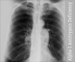 Alpha-1 Antitrypsin Deficiency-Signs-Symptoms-Diagnosis-Treatment-FAQs