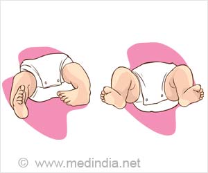 Arthrogryposis - Types, Causes, Clinical features, Diagnosis and Treatment