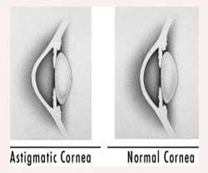 Astigmatism - Causes Symptoms Diagnosis Treatment FAQs