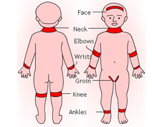 Atopic Dermatitis / Eczema  - Causes - Symptoms - Diagnosis - Treatment - FAQs