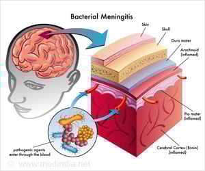 Bacterial Meningitis - Causes, Symptoms, Diagnosis, Treatment & Prevention