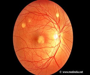 Best Disease / Vitelliform Macular Dystrophy - Symptoms – Diagnosis - Treatment