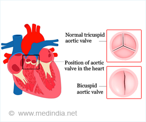 Bicuspid Aortic Valve - Causes, Symptoms, Complications, Diagnosis, Treatment, Prevention & Precautions