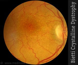 Bietti Crystalline Dystrophy (BCD) - Clinical Features Diagnosis Management 