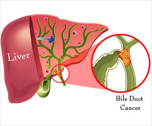 Bile Duct Cancer | Cholangiocarcinoma - Causes, Risk Factors, Symptoms,  Diagnosis, Stages, Treatment, Support Groups