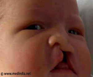 Birth Defects - Structural Defects - Neural Tube Defects - Hypospadias