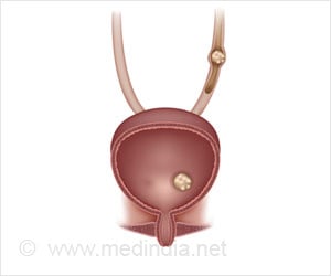 Bladder Stones | Vesical Calculi - Causes, Symptoms, Diagnosis, Treatment, Prevention