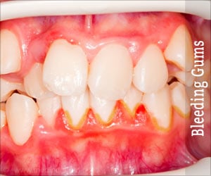 Bleeding Gums - Causes, Symptoms, Diagnosis & Treatment