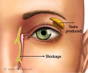 Blocked Tear Duct  - Causes - Symptoms - Diagnosis - Treatment - FAQs