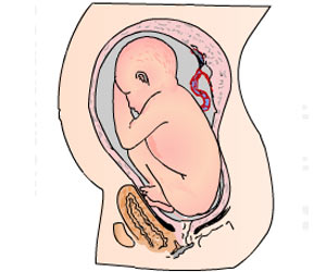 Breech Presentation and Delivery / Breech Birth