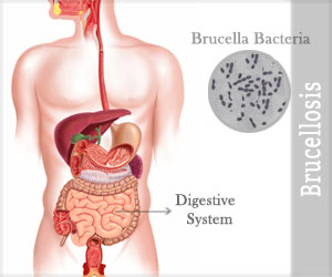 Brucellosis - Symptoms and Signs, Diagnosis, Treatment, Prevention