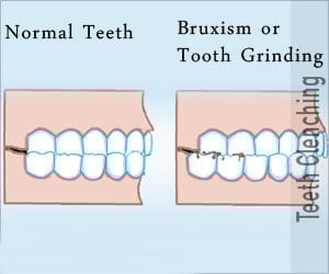Bruxism - Incidence Causes Diagnosis Treatment Prevention FAQs