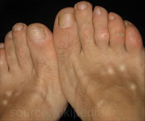 Calcinosis - Types, Causes, Symptoms, Diagnosis, Treatment