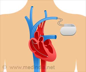 Cardiac Pacemaker for Abnormal Heart Rhythms – Types, Advantages & Risks