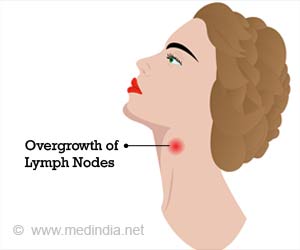 Castleman Disease (CD) - Causes, Symptoms, Diagnosis, Treatment, Prevention and Prognosis